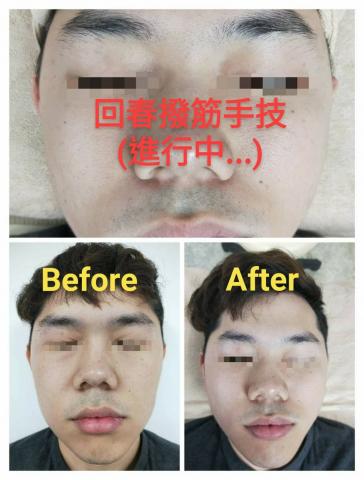 天使美妍坊 - 顧客案例分享~
回春撥筋手技搭心型氣刷及特殊臉部精油,護膚前後對照如圖,粉刺毛孔粗大明顯改善,下垂肌都拉提上去了! :-)