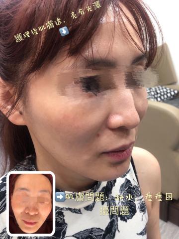 奇霓嬡著迷時尚奢華坊 - 特地來本店體驗臉部護理?
帶著2個小朋友一起前來
好?開心
偶像本身肌膚滿不錯零毛孔，只有些許小問題

肌膚問題：缺水補水不足，保濕度也不夠還有自己看痘痘不順眼把它擠成發炎?

經由Bubu護理後
偶像肌膚光澤，原本痘痘膿皰處擦上✨（有機茶樹痘痘棒精華）✨防止發炎跟色素沈澱
主要成分：
茶樹精油-抑菌消炎
檸檬精油-消炎
金盞花純露-純植物配方並沒有精油，最多只有浸泡油，所以金盞花所蒸餾的金