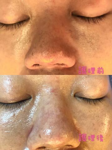 奇霓嬡著迷時尚奢華坊 - 今天男顧客肌膚問題：嚴重黑頭粉刺跟肌膚長期缺水危機
經由美容師Bubu護理後
男顧客肌膚亮白有光澤，男顧客說感覺肌膚護理後非常清爽而且整個人氣色看起來很好
美容師建議男顧客還是定時回來護理
回家也是好好徹底卸妝+（雪精靈洗顏慕斯）洗臉完後用面紙稍壓乾即可，千萬不要用毛巾較容易會有細菌及嚴重摩擦的問題
➡️基本保養（✨✨雪精靈保濕菁露➕花蜜柔妍精華凝乳✨✨）簡單又方便不用大大小小這麼多瓶保養
三瓶就