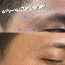 love-ideal專業肌膚美學 - 凹洞處理