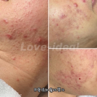 love-ideal專業肌膚美學 - 痘痘處理