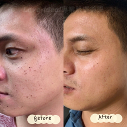 love-ideal專業肌膚美學 - 點斑處理