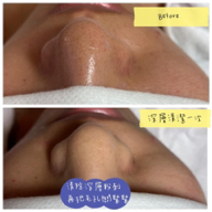 love-ideal專業肌膚美學 - 無痛粉刺