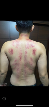 亭亭❤️❤️ - 刮痧