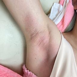 艾默力 男性除毛 -  腋下