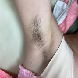 艾默力 男性除毛 - 腋下