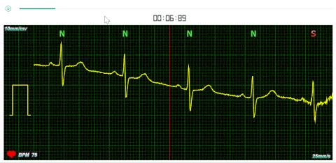 陳柏亨 - 健康檢測 心電圖