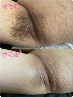 Chen Qian Yu - 除毛前後差別