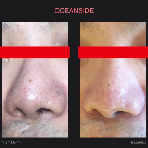 Parfum HK - 跟粉刺說Bye Bye