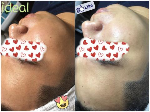 王文穗 - 客人做臉前後對比圖，完全零美肌。