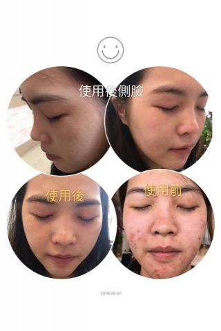 水銥釩美學SPA - 藻針