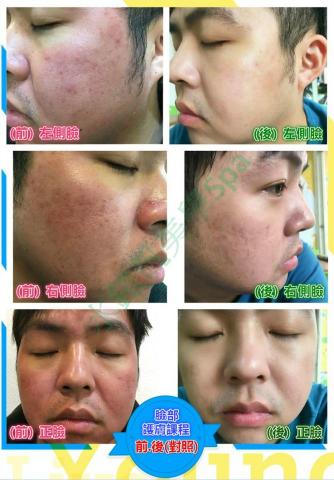 水銥釩美學SPA - 藻針