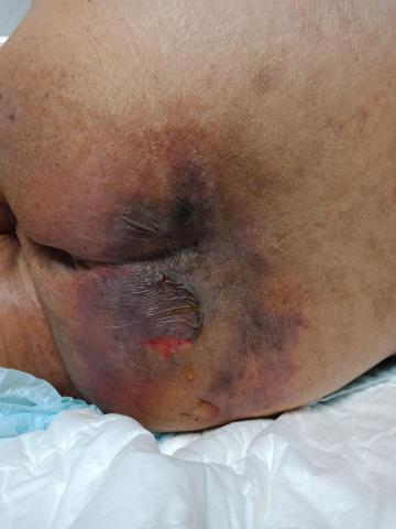 佳恩全方位照顧社 - 10.壓瘡（入瘡）治療。