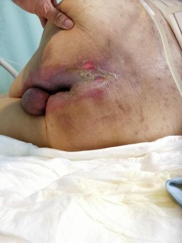 佳恩全方位照顧社 - 9.壓瘡（入瘡）治療。