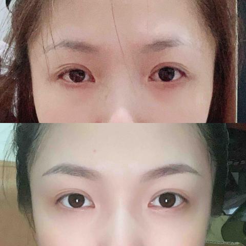 Peggy  - 霧眉脱痂後