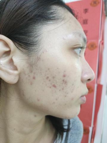 艾美美顏美甲小鋪 - 痘痘肌