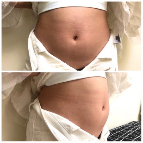 Mimiann 美容美學 - 年過30的困擾-小腹突出1