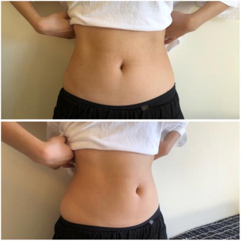 Mimiann 美容美學 - 年過30的困擾-小腹突出成效3