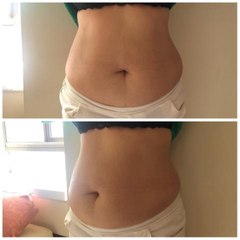 Mimiann 美容美學 - 媽媽的願望-減少脂肪成效