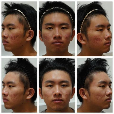 Color Fashion HC skin care 岡山店 - 痘痘