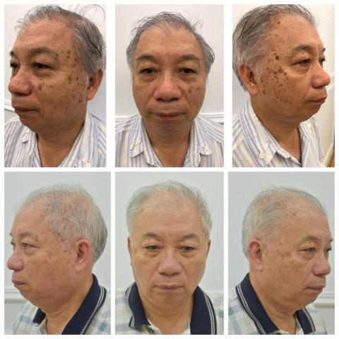 Color Fashion HC skin care 岡山店 - 老人斑、角化斑保養後