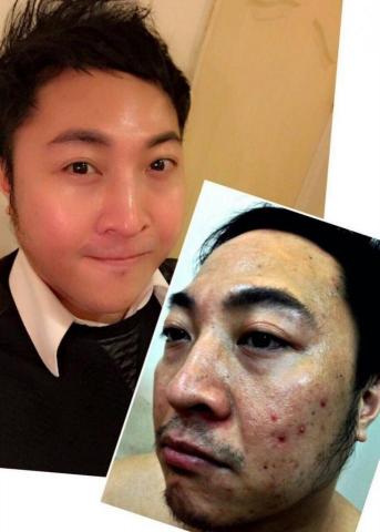 范姜語褀 - 痘痘，痘疤