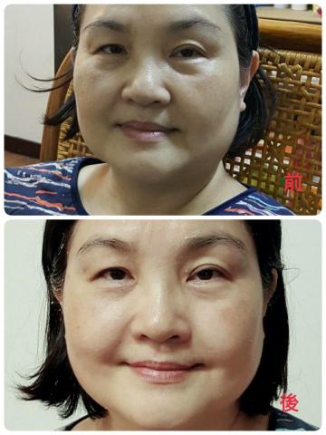 莊小君 - 做臉前後