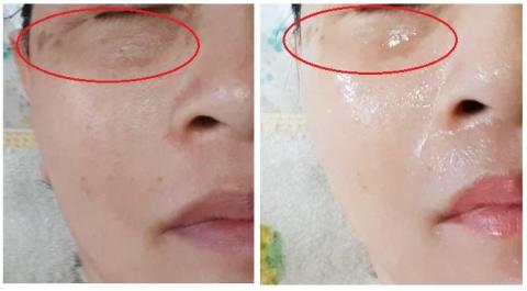 楊禮嘉 - 淡化黑眼圈