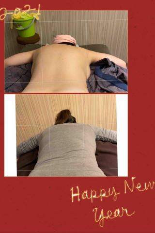 南庭甄 - 上：調整前左背隆起 下：調整數次之後平整許多