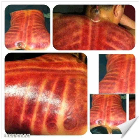 南庭甄 - 專業滑罐手法。本身我也是按摩講師