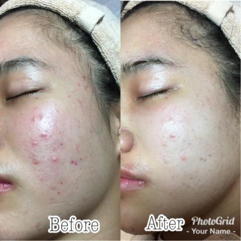 珞蕾爾美學概念會館-宥希/欣儂 - 粉刺減少. 痘痘消退