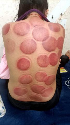 紫柔工作室 指壓油壓推拿 臉部保養 身體去角質 修指甲 修腳 - 拔罐刮痧