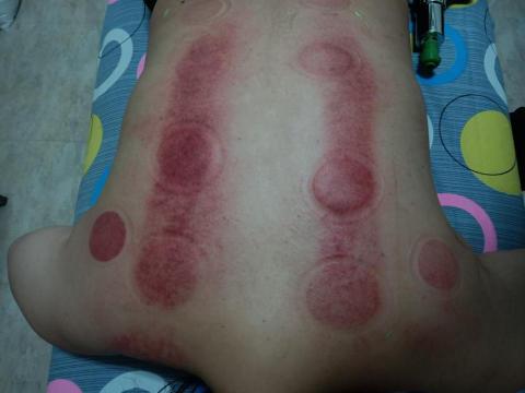 蘇哲徵 - 刮痧拔罐