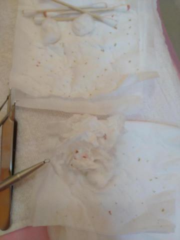 Jennie beauty - 某客人ㄉ粉刺寶寶們