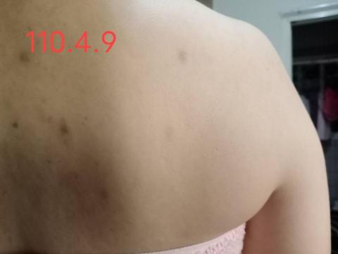 碧森妮芳香療癒諮詢顧問 - 肩膀背部汗斑治療過程(治療後)
拍攝於110.4.9