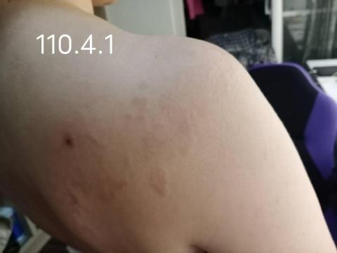 碧森妮芳香療癒諮詢顧問 - 肩膀背部汗斑治療過程(治療前)
拍攝於110.4.1