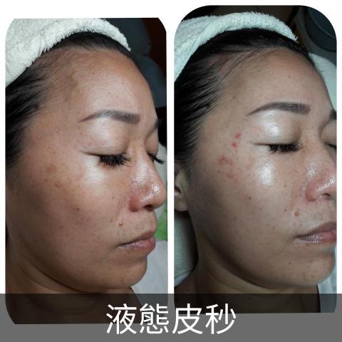 詩育特睫妍 - 液態皮秒