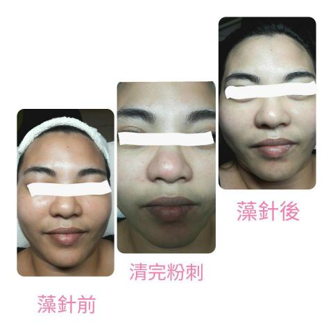 詩育特睫妍 - 藻針美容