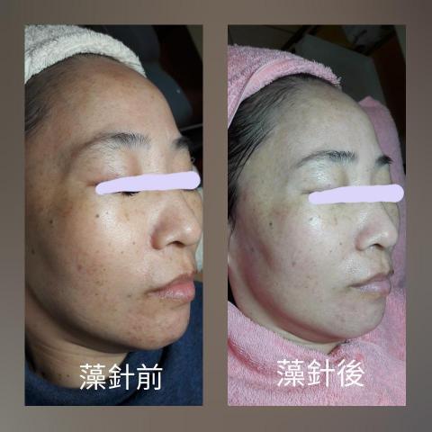 詩育特睫妍 - 藻針美容