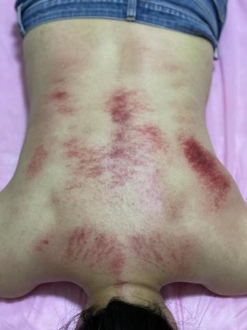 詩育特睫妍 - 擀筋刮痧