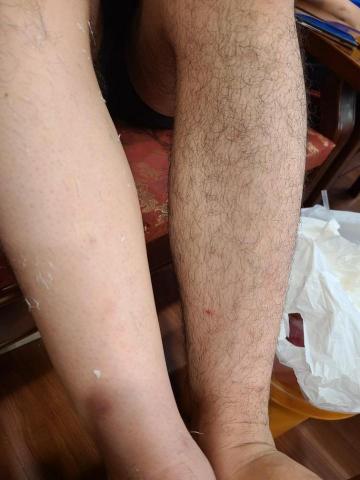 桃園 居家工作室 - 熱蠟除毛 小腿對比