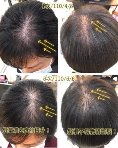 林紫柔馥華髮型 - 頭皮調理   調理後掉髮量減少髮量濃密度回來

