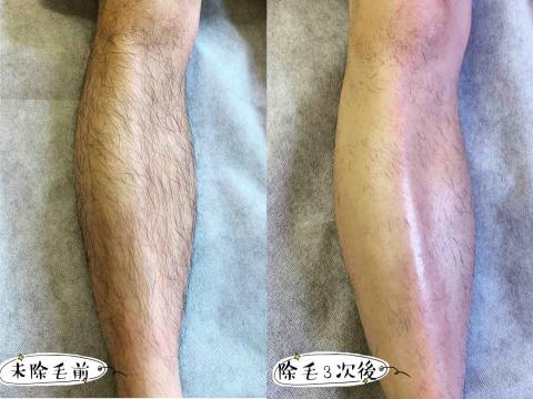 Good Mood Studio - 小腿除毛3次