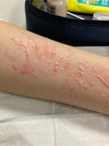 Bettine Makeup彩妝工作室 - 疹子特效妝