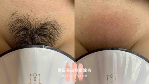 尊宓美學工作室 - 熱蠟除毛-巴西式全除