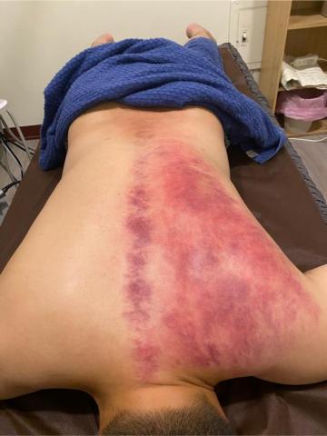 筑元足體舒鬆館 - 只是筋膜鬆開而已，氣滯血瘀就跑出來了