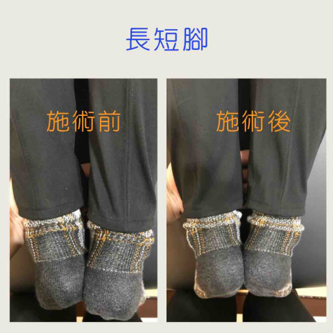 好心晴整體平衡 - 骨盆歪斜導致有長短腳的狀況出現，經過調理後骨盆平衡同時長短腳的狀況改善