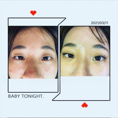 林芠憶 - 單眼皮嫁接睫毛