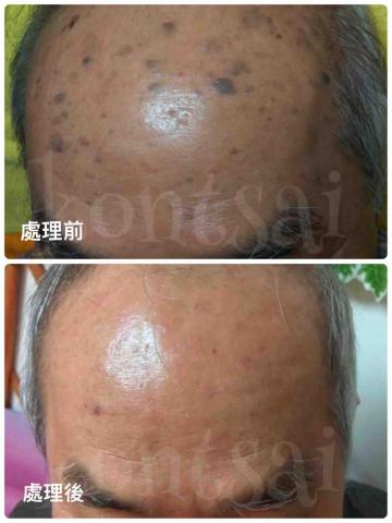 🔅靖雯撥筋護膚師🔅 - 各種斑點問題處理