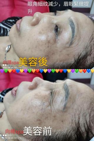 向陽美容spa - 眼部抗衰老，整個眉眼已舒展開，眼紋減少